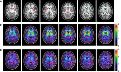 Striatal Volume Increase After Six Weeks of Selective Dopamine D2/3 Receptor Blockade in First-Episode, Antipsychotic-Naïve Schizophrenia Patients